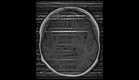 Herringbone Artifact Mri Rf Spike Artifact