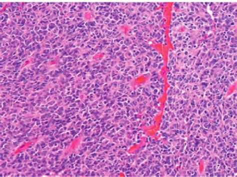 Photographs Showing A Cellular Poorly Differentiated Tumor Composed Of