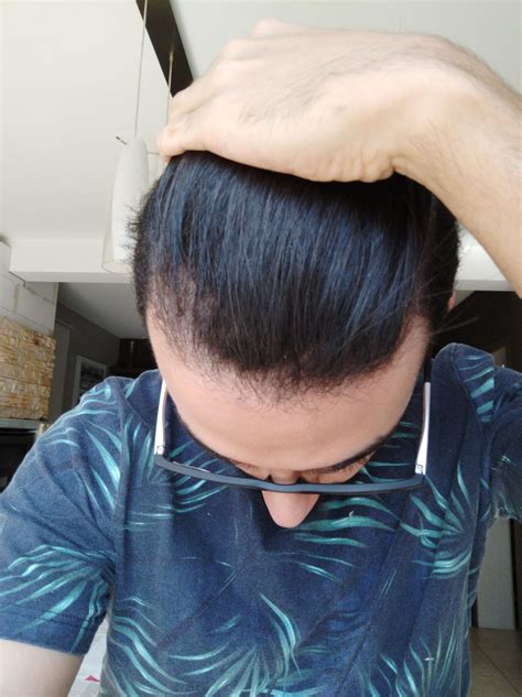 24 yo, noticed some thinner spots on my head recently. Do you guys