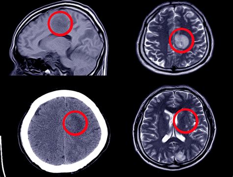 Ct Scan Of Brain Showing Intracerebral Haemorrhage Axial View