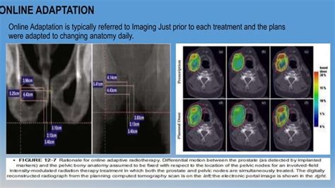 Complete Overview On Adaptive Radiotherapy Over Daily Image Guided Radiotherapy Ppt