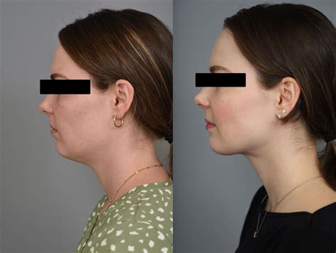 [before and after] Chin lipo results! 4 months post op : r/PlasticSurgery