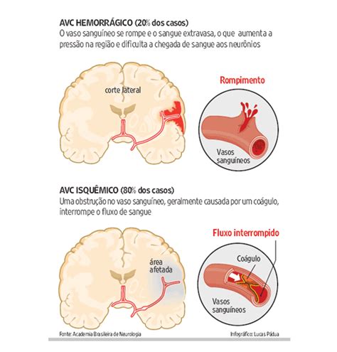 O Que Causa Acidente Vascular Cerebral - Saúde e bem estar: O que é Acidente Vascular Cerebral?