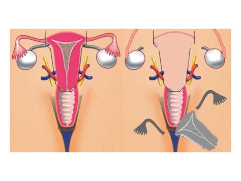 Hysterectomy Anatomy