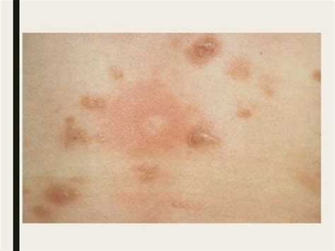 Mastocytosis Skin Rash