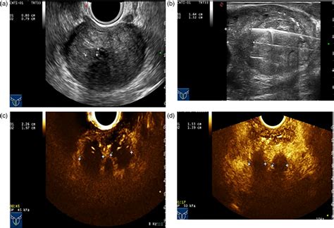 Ultrasound Guided Perineal Laser Ablation Versus Prostatic Arterial Embolization For Benign