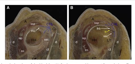 [PDF] The anatomy of the coracohumeral ligament and its relation to the ...