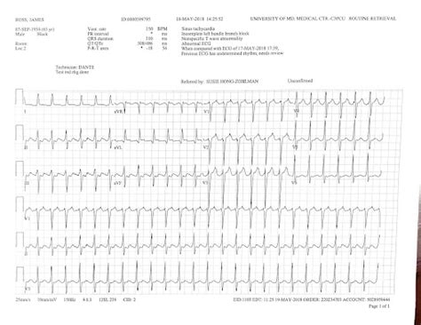 The Bix Rule In Narrow Complex Tachycardia Ecg Weekly