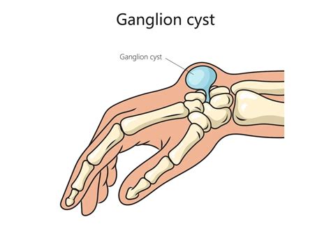 ganglion cyst retinacular cyst hand  nerve surgeon