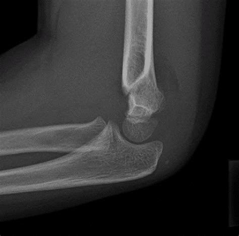 supracondylar fracture  humerus kyhery