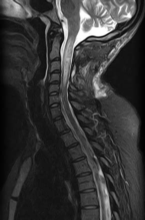 Spinal Ependymoma Radiology Reference Article Radiopaedia Org