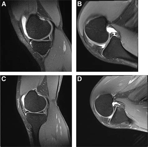 Posterior Displacement Of Meniscal Ramp Lesion Is Observed On Flexed