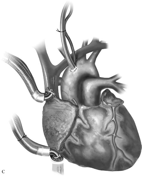 Continued C Bicaval Cannulation Is Performed When The Patient Has A