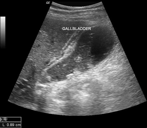 Acalculous Cholecystitis Ultrasound
