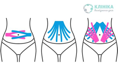 Тейпирование Живота При Диастазе Фото — Картинки фотографии