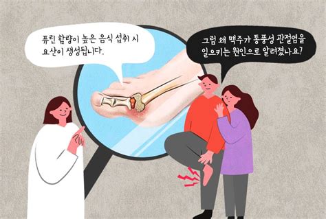 통풍성 관절염 유발하는 나쁜 조합 헬스코리아뉴스