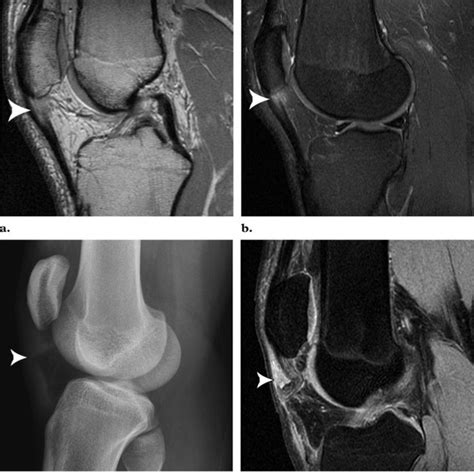 Patellar sleeve fracture in an 11-year-old boy who was injured when he ...