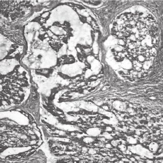 Basal cell carcinoma of the vulva. | Download Scientific Diagram