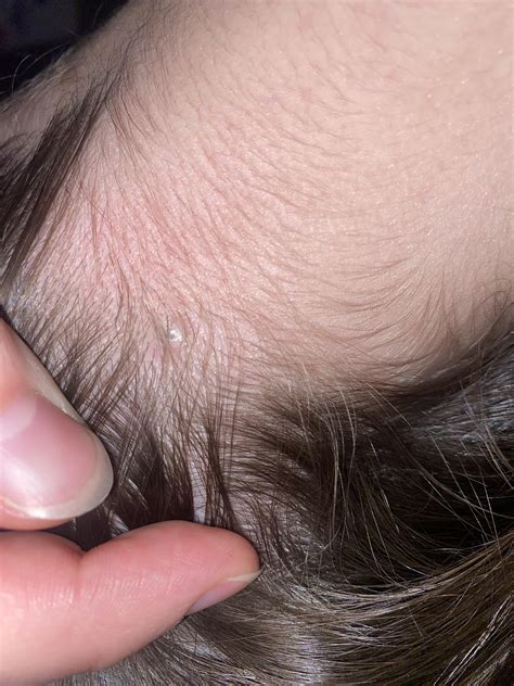 Mole or cyst on the back of my scalp, nape of neck : r/Dermatology
