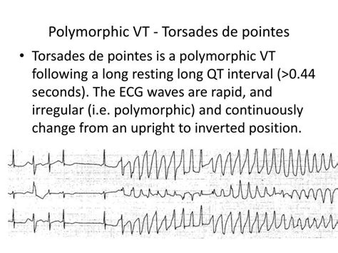 Ppt Ventricular Tachycardia Powerpoint Presentation Id2156853