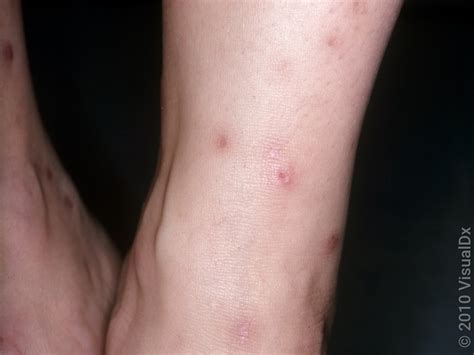 Flea Bites On Humans Pictures Of Fleas And Flea Bites Goodrx
