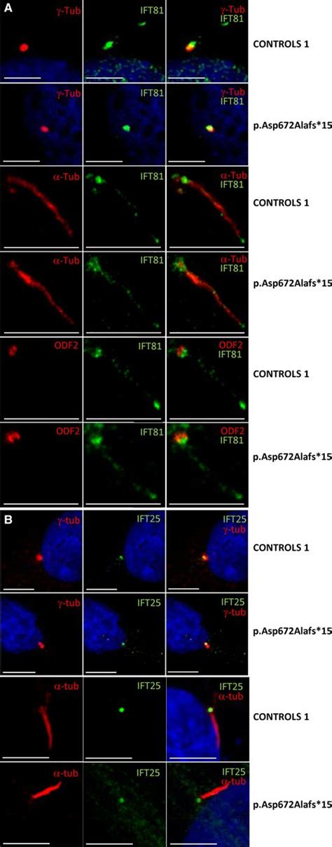 IFT81 localises to primary cilia with enrichment at base and tip ...
