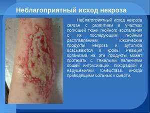 Как лечить некроз тканей – причины и признаки омертвения кожи, как ...