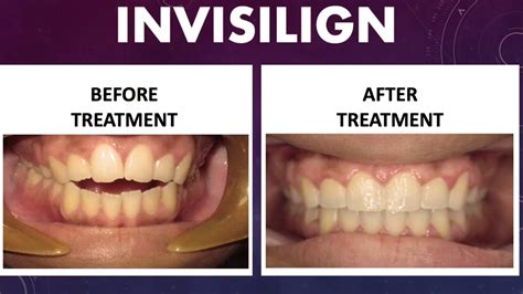 Invisalign Treatment Open Bite Youtube