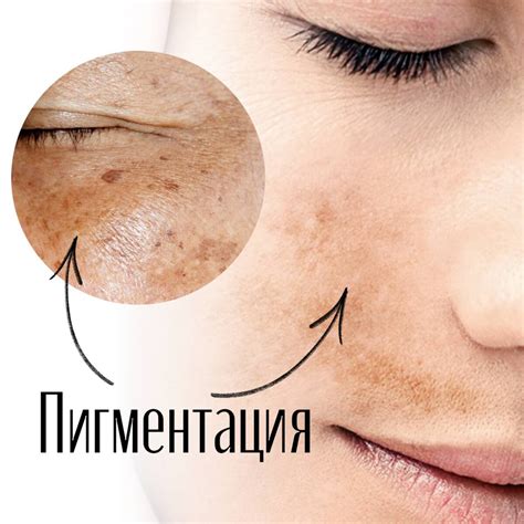 Пигментация: истинные причины, что смотреть в анализах? | Лейла ...