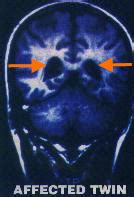Schizophrenia.com - Schizophrenia Genetics and Heredity
