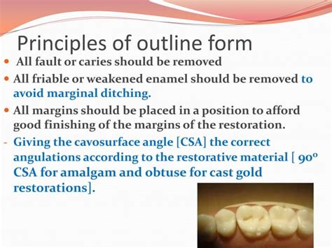 Principles Of Cavity Preparation Ppt