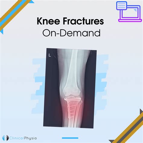 Knee Fractures On-Demand Webinar | Clinical Physio