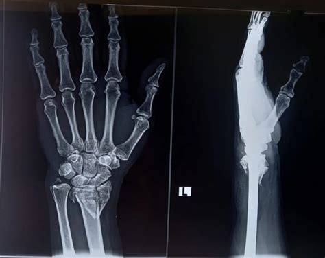 case  bone fracture