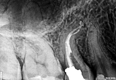 Enjoy Minimally Invasive Endodontics With Laser Activated Irrigation