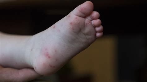 Hand foot mouth disease Cairns: Dozens of cases at FNQ day cares | The ...