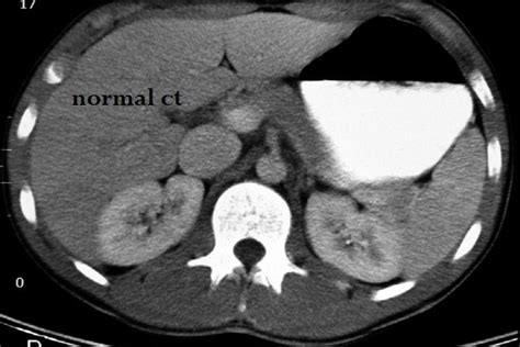 CT abdomen with contrast the suspect multiple hepatic nodules ...