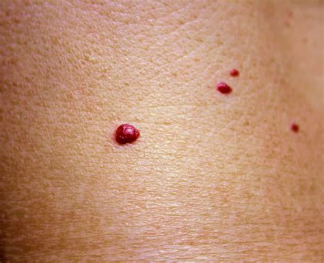 Why Do I Have Blood Spots On My Chest Design Talk
