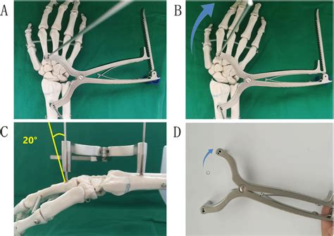 One 20 Steinmann Pin Was Drilled Into The Proximal Of The Second