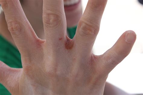 The time I broke my toe. 4/20/13 | our little fairy tale