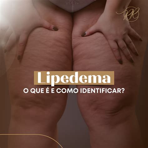 Lipedema O Que E Como Identificar Dra Renata Rebello