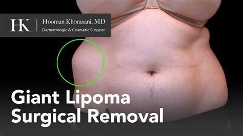 How To Remove A Giant Lipoma Of The Abdomen Dr Hooman Khorasani