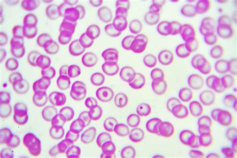 Anemia In Atrial Fibrillation Linked To Increased Bleeding Risk