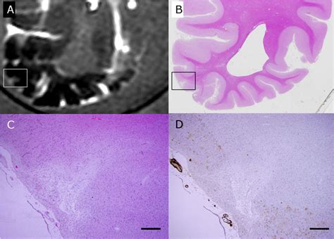 Figure From Comparative Analysis Of Cortical Microinfarcts And