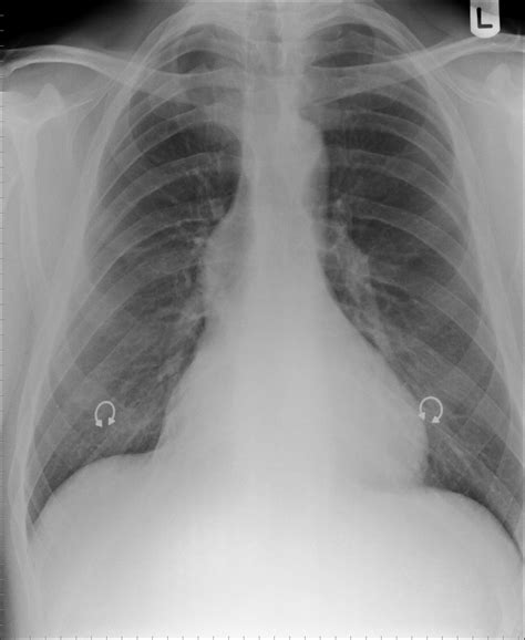 X Ray Images Of Aortic Tear