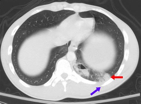 Pulmonary Contusion Wikidoc