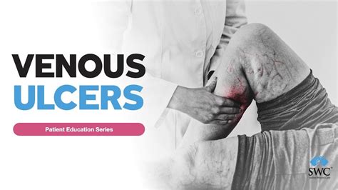 Venous Ulcer Patient Education Series Youtube