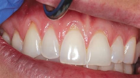 Diagnosis And Treatment Of Gingival Recession Decisions In Dentistry