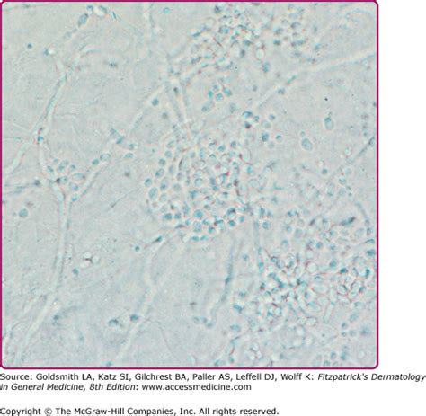 Yeast Infections Candidiasis Tinea Pityriasis Versicolor And