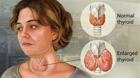 Goiter What It Is Causes Symptoms Diagnosis And Treatment Lutheran Media Ministry