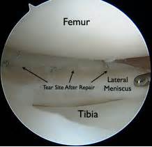 Torn Meniscus Recovery Time Town Center Orthopaedics